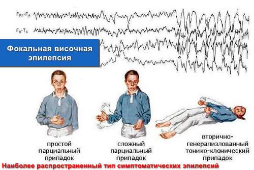 Фокальная височная эпилепсия