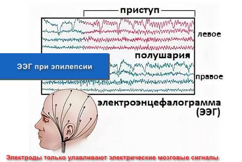 ЭЭГ при эпилепсии