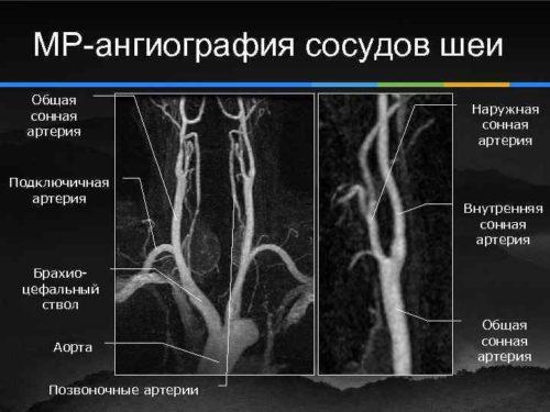 Ангиография сосудов шеи