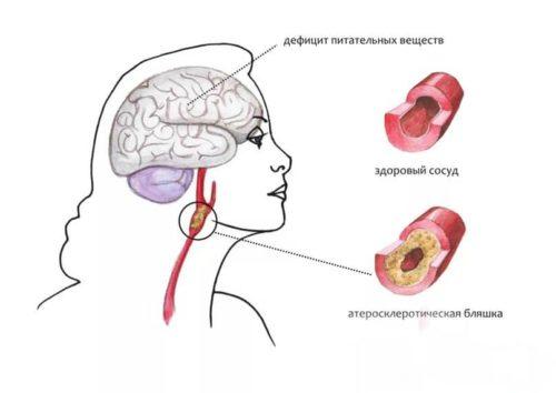 Атеросклероз головного мозга