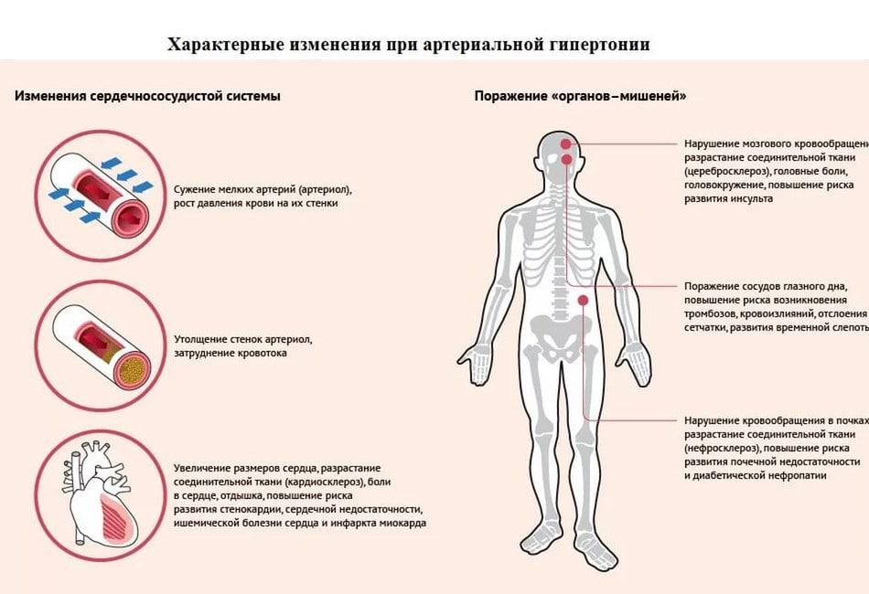 Боли при артериальной гипертонии