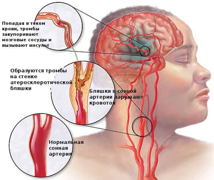 Болит голова в висках