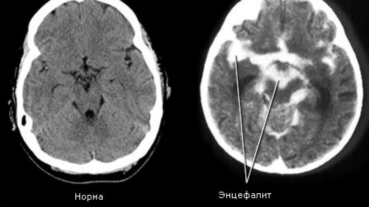 Диагностика энцефалита