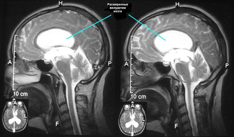 Диагностика гидроцефалии