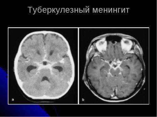 Диагностика туберкулезного менингита