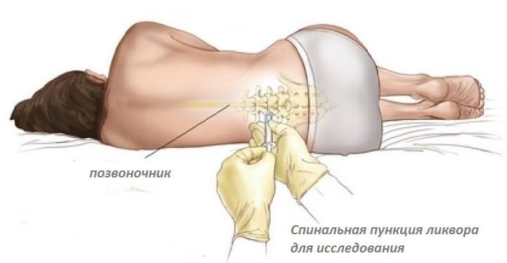 Диагностика вирусного менингита