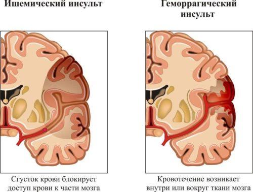 Геморрагический инсульт