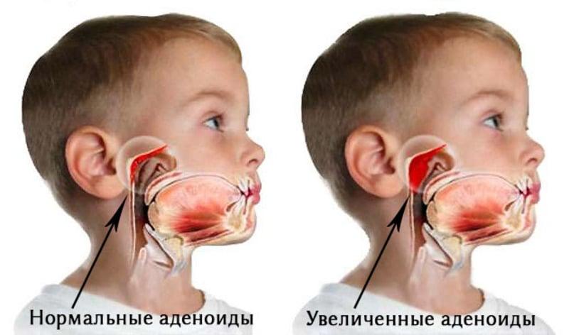 Храп у детей при аденоидах