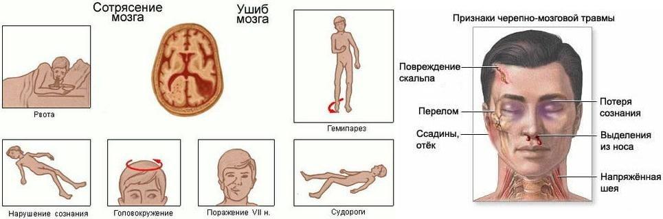 Легкое сотрясение головного мозга