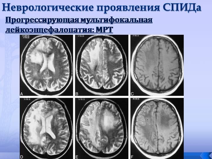 Лейкоэнцефалопатия на МРТ