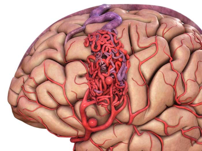 Мальформация сосудов головного мозга