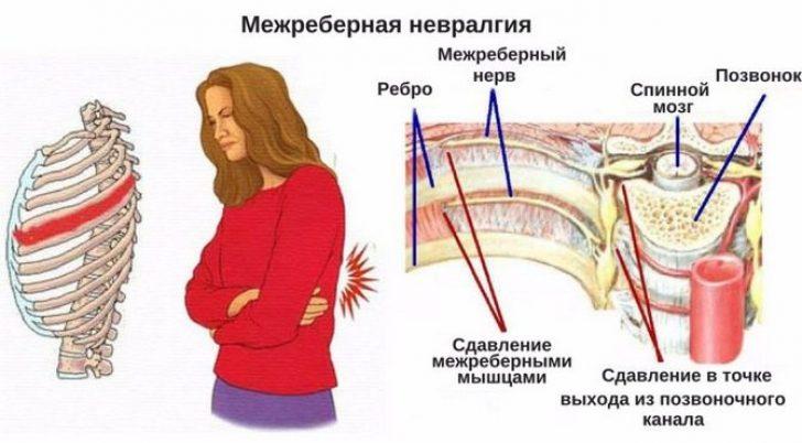 Межреберная невралгия