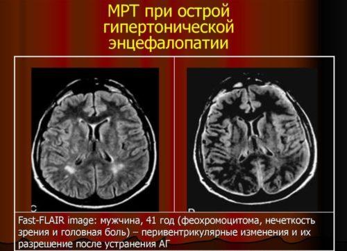 Мрт при гипертензивной энцефалопатии