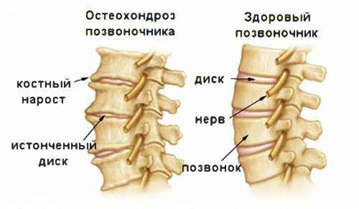 Остеохондроз позвоночника