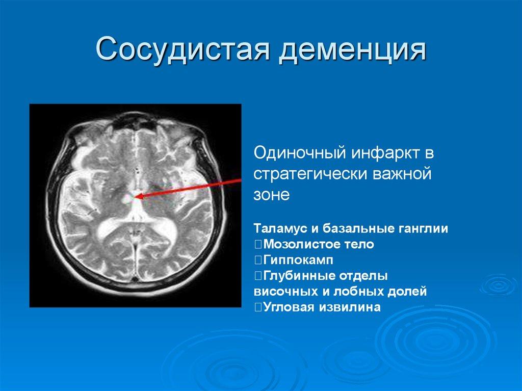 Причины сосудистой деменции