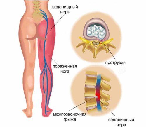 Причины защемления нерва в ноге