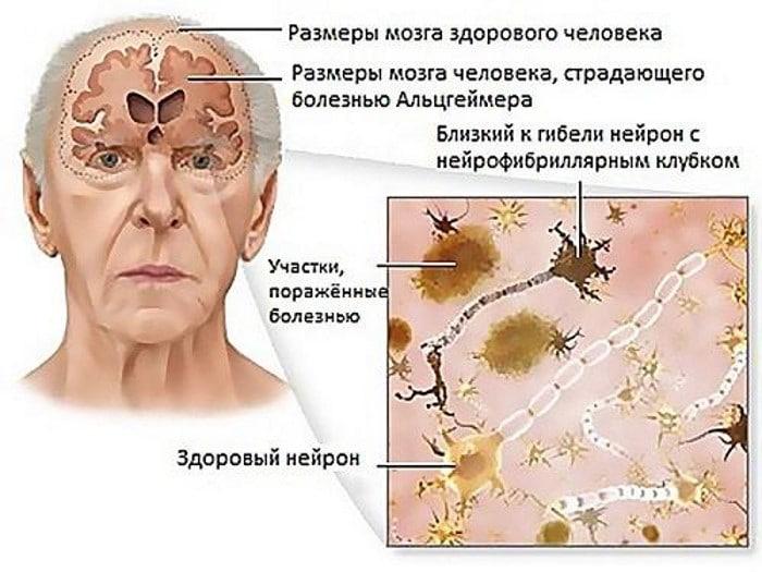 Признаки деменции