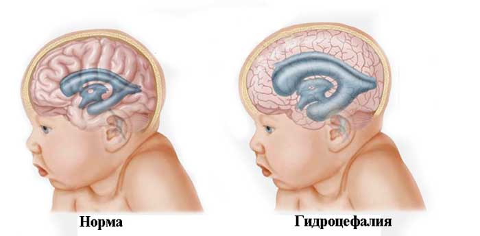Признаки гидроцефалии