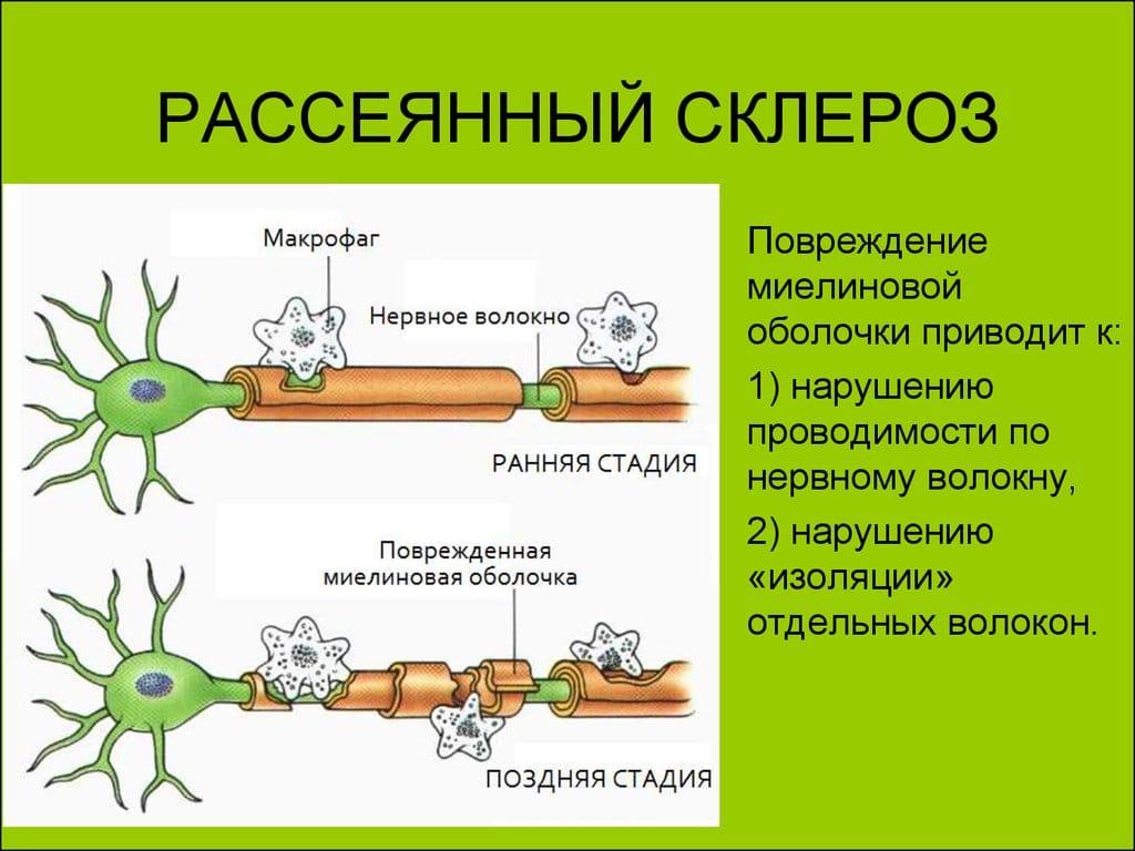 Признаки рассеянного склероза