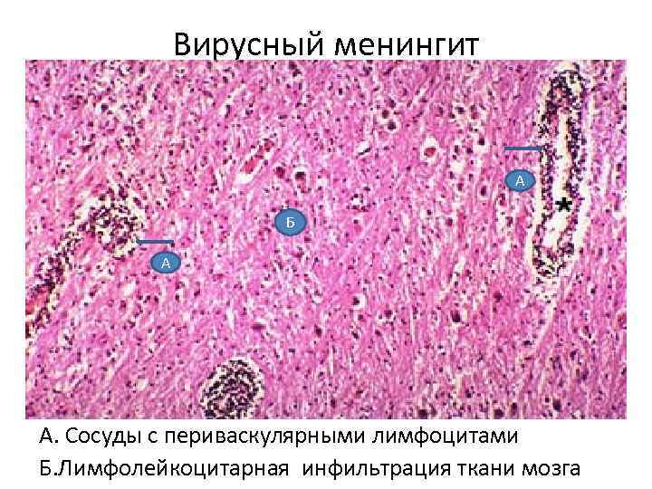 Признаки вирусного менингита