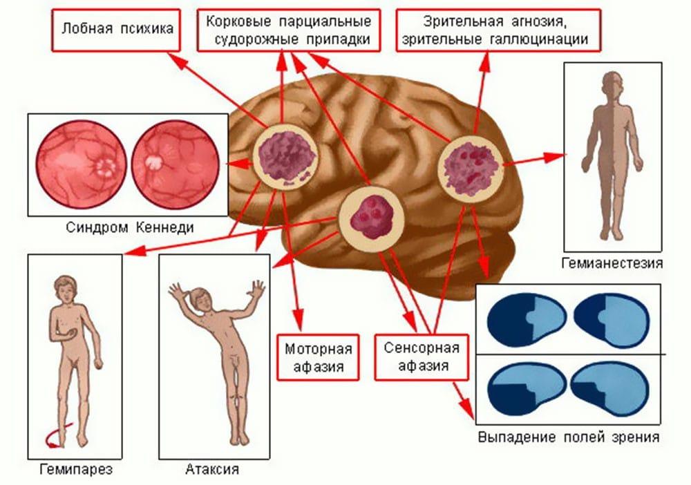 Рак головного мозга