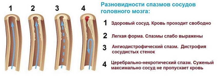 Разновидности спазмов сосудов