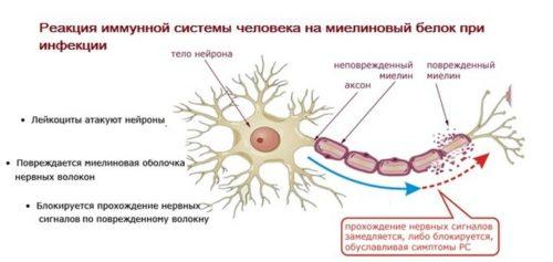 Разрушение миелиновой оболочки