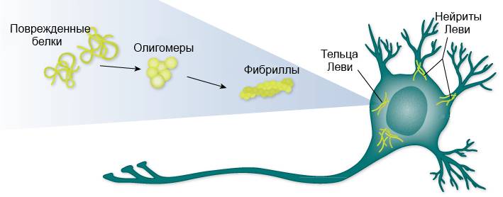 Симптомы деменции с тельцами Леви