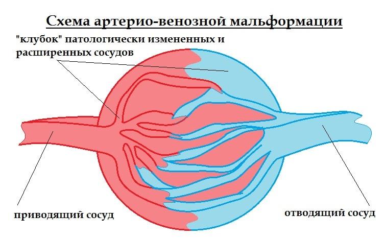 Симптомы мальформации сосудов головного мозга