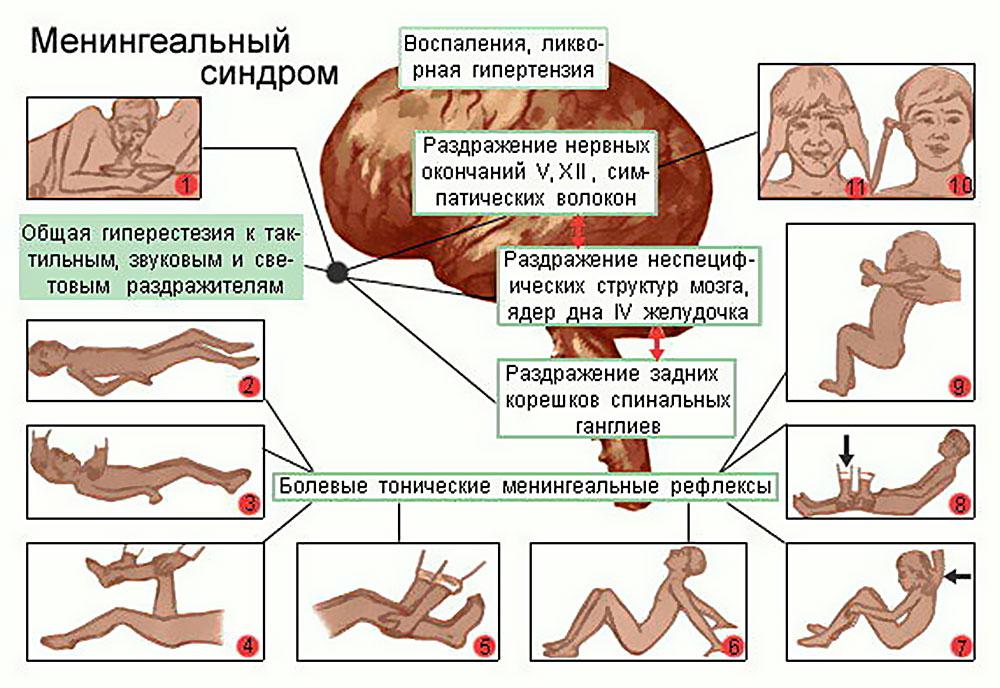 Симптомы менингита