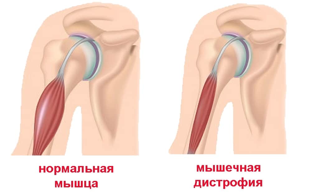 Симптомы миотонии