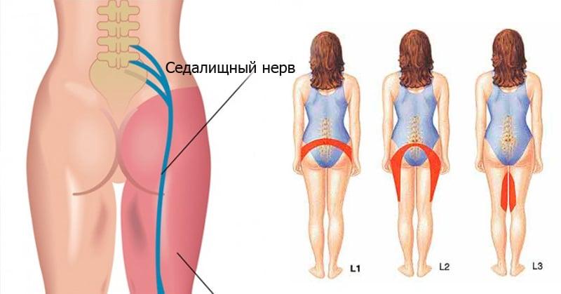 Симптомы защемления седалищного нерва