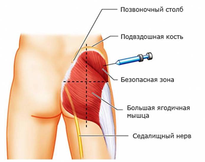 Техника блокады седалищного нерва