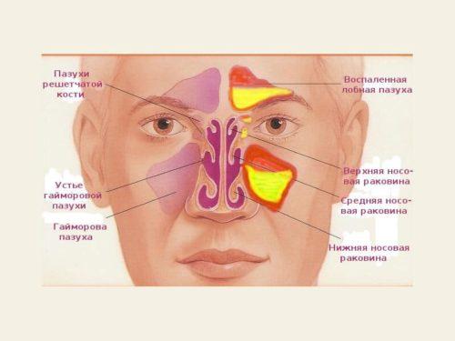 Воспаление лобной пазухи