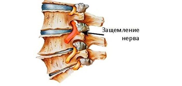 Защемление нерва