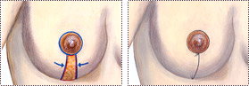 Уменьшение груди в топ-клинике Этианум, Гейдельберг, Германия