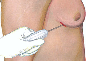 Операции по уменьшению груди у мужчин в топ-клинике Этианум, Гейдельберг, Германия